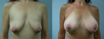 Breast Augmentation