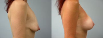 Breast Augmentation2