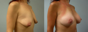 Breast Augmentation3