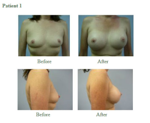 Breast Augmentation4