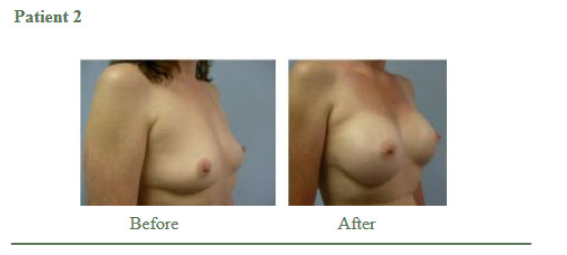 Breast Augmentation5