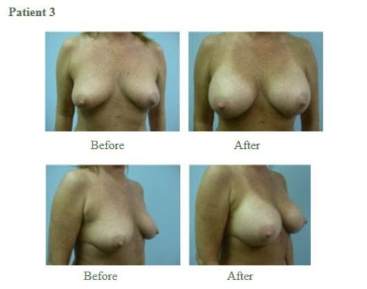 Breast Augmentation6