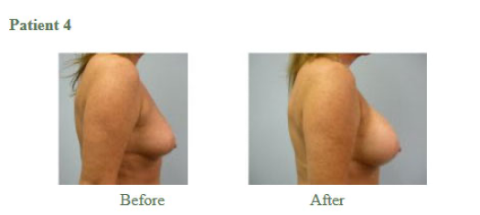 Breast Augmentation7