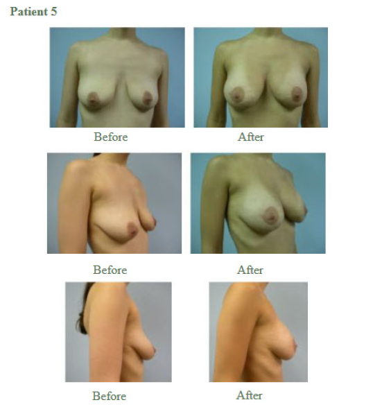 Breast Augmentation8