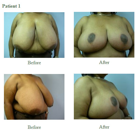 Breast Reduction Results