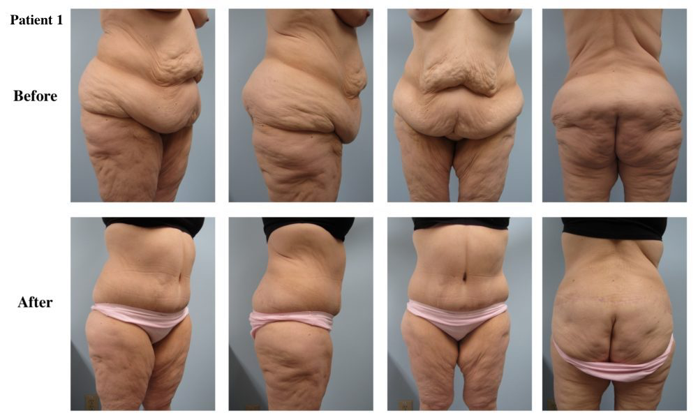 Circumferential Body Lift Results