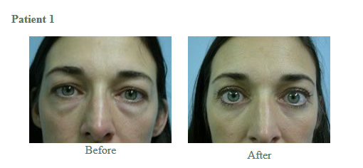 Cosmetic Eyelid Surgery