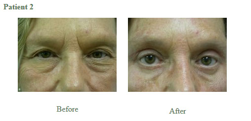 Cosmetic Eyelid Surgery2