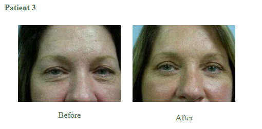 Cosmetic Eyelid Surgery3