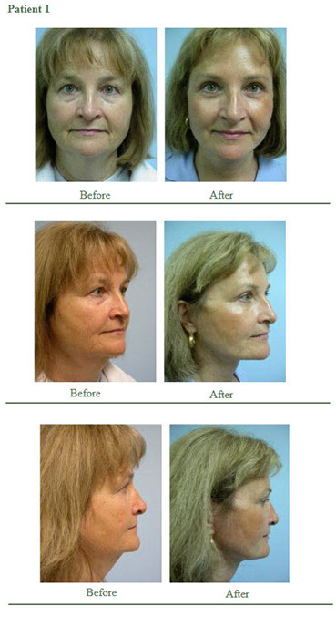 Face Lift Results