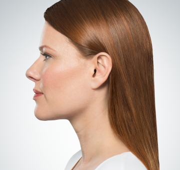 Kybella