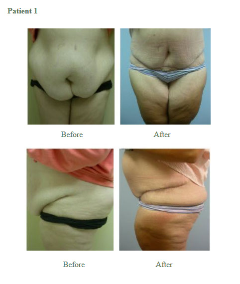 Panniculectomy Results