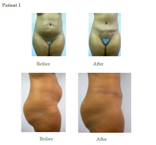 Tummy Tuck Results