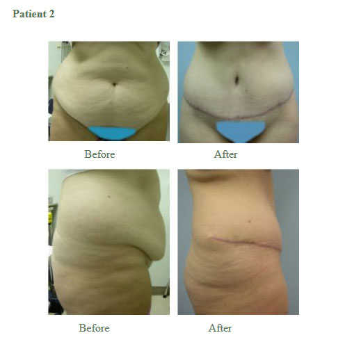 Tummy Tuck Results2