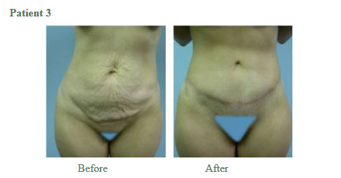 Tummy Tuck Results3