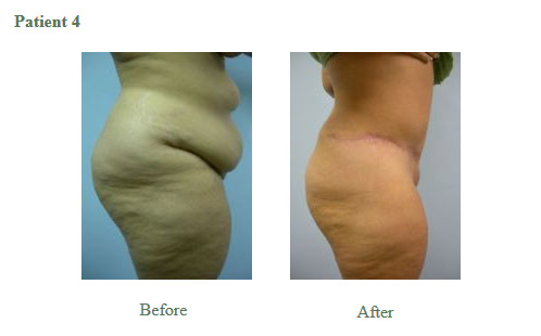 Tummy Tuck Results4